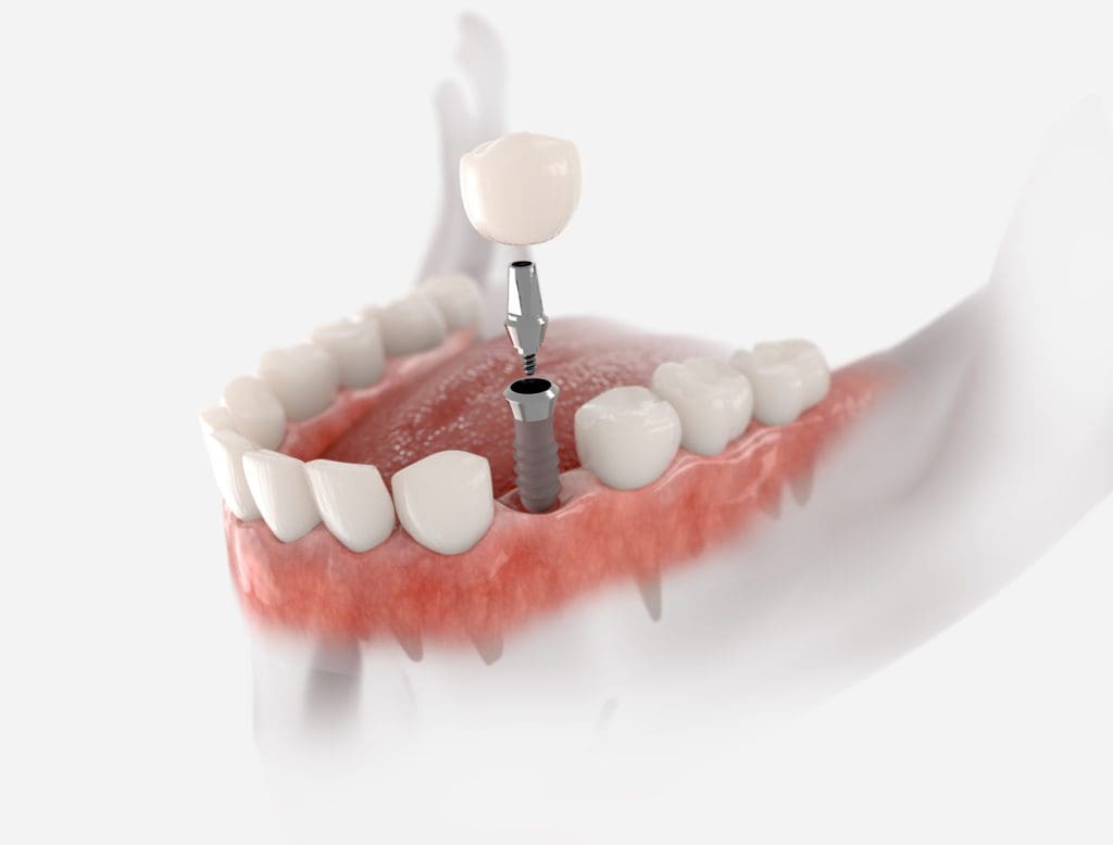 dental implants in Baltimore, MD