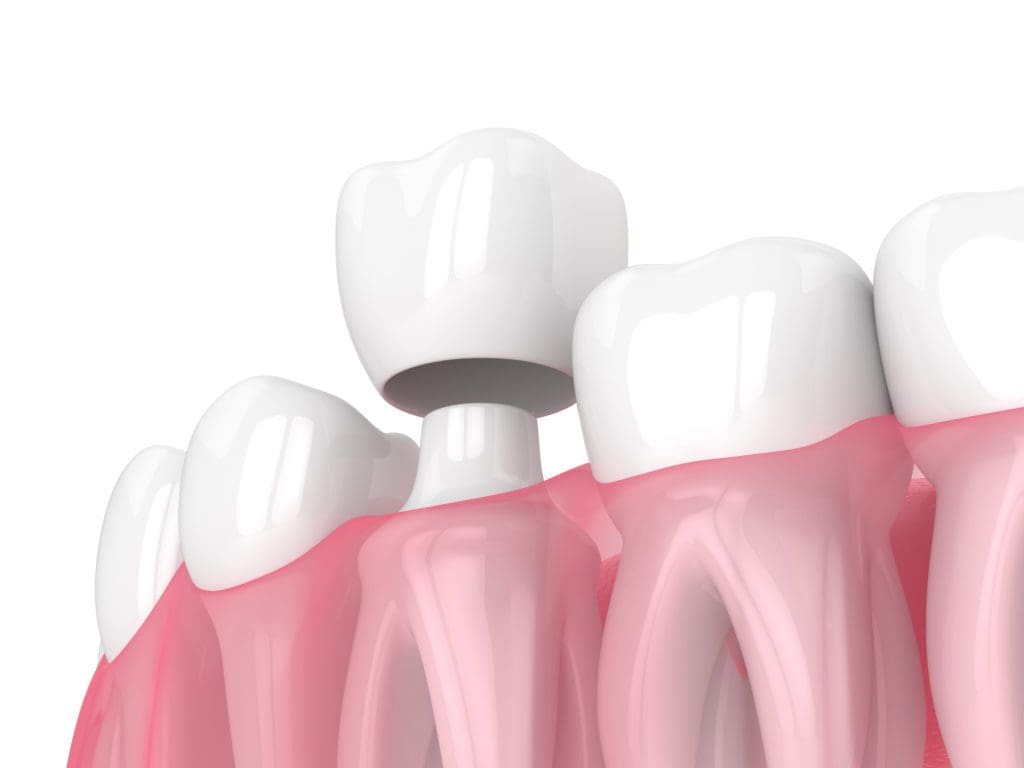 Dental Crowns in Baltimore, Maryland