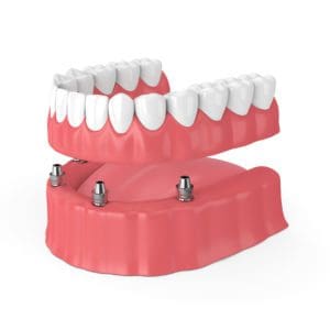 Full and Partial Dentures in Baltimore, Maryland