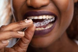 Invisalign Aligners in Baltimore, Maryland
