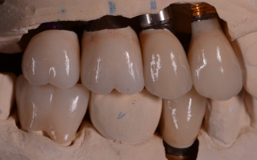 Restore Missing Teeth in Baltimore, Maryland