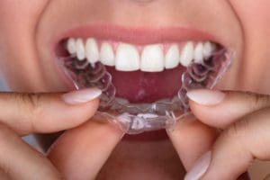 The Benefits of Invisalign