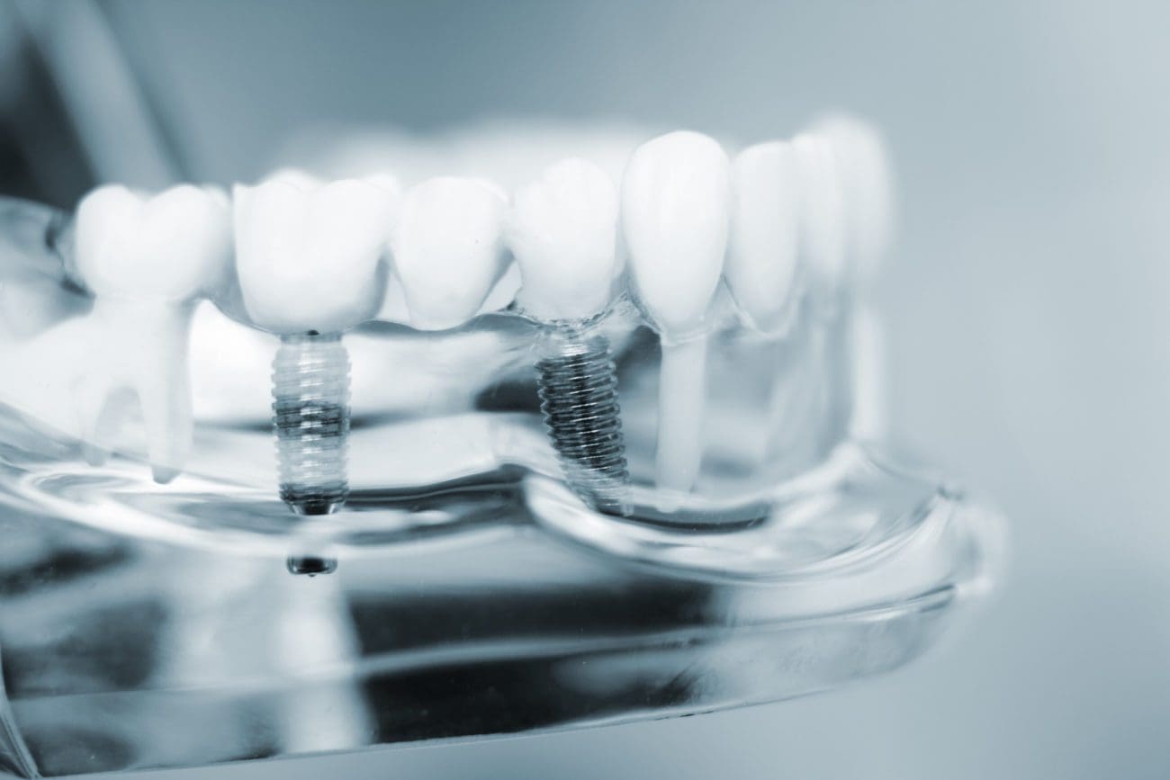 Dental implants