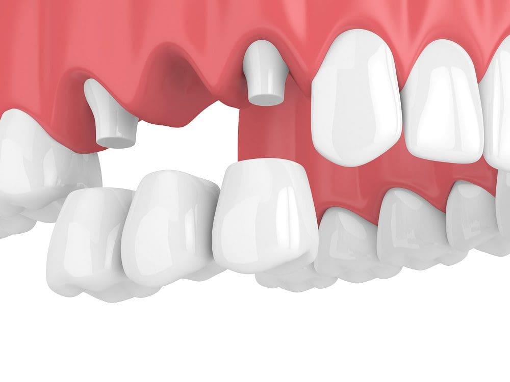A Dental Bridge in Baltimore MD needs routine care to keep it strong