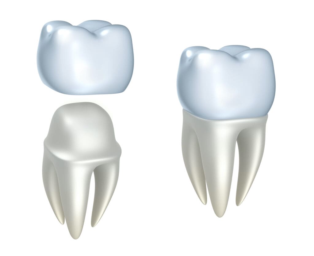 If you lose a Dental Crown in Baltimore MD, timing is crucial for treatment