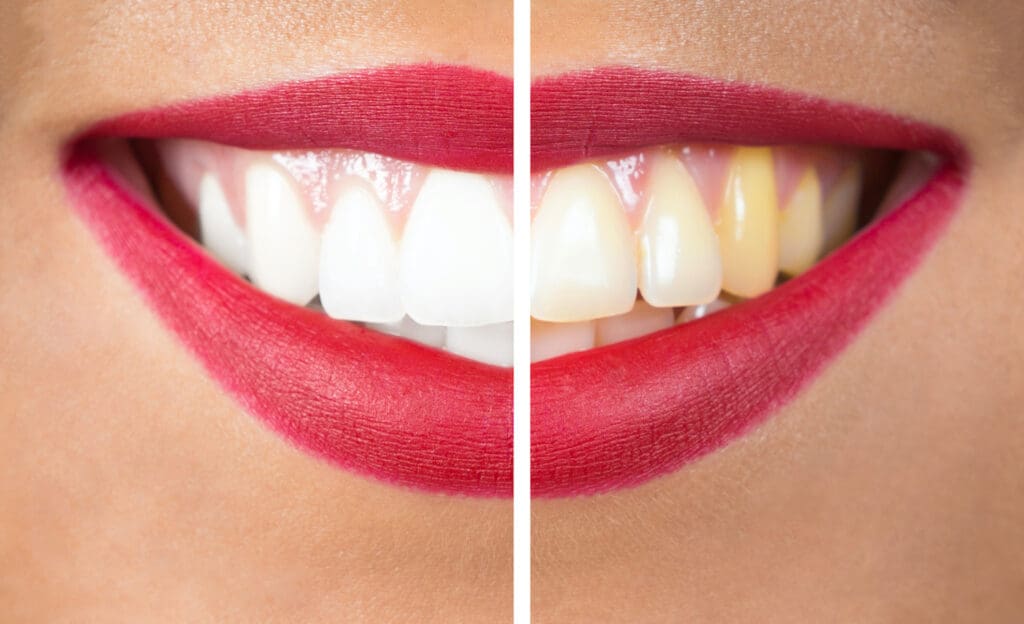 Teeth Whitening in Baltimore MD could help improve the look of your smile