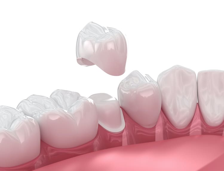 Dental crowns serve as essential tools in modern dentistry. Dentists often suggest crowns for various reasons.