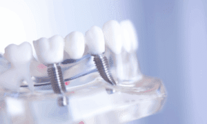 Dental Implant vs. Bridge: Which is for You? in Hanover, MD