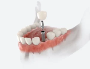 What It's Really Like to Get a Dental Implant in Hanover, MD