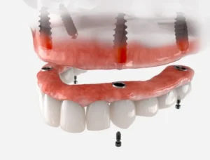 Dentures vs. Implants: How to Choose in Baltimore, MD