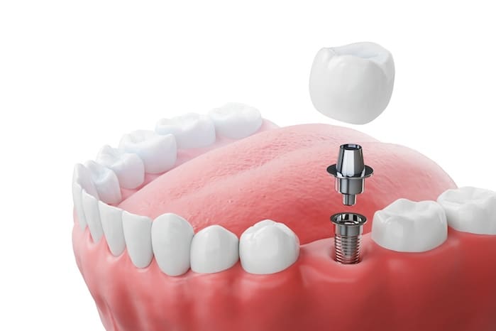 getting dental implants in gambrills, md