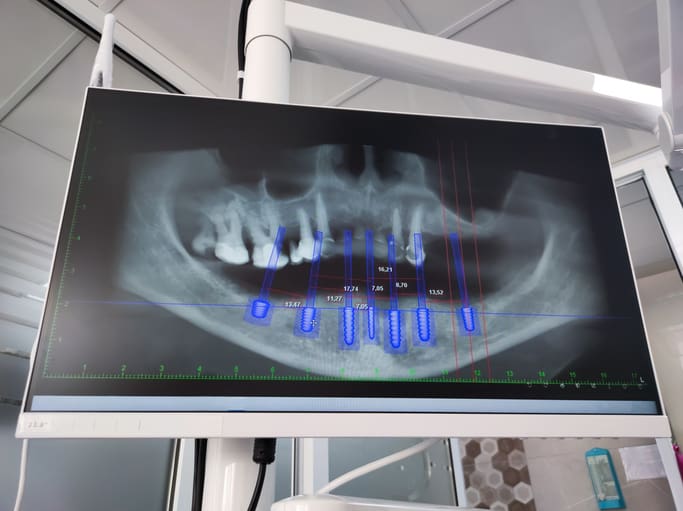 dental implant placement in baltimore, md